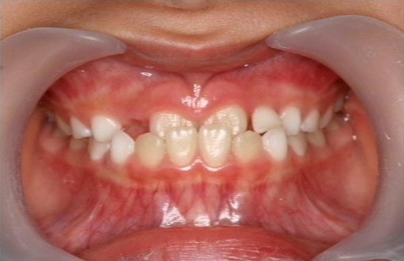 久喜市 久喜の矯正・矯正歯科の関根歯科医院のお子さまの歯並びについて